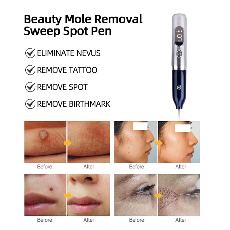 Laser Plasma Pen for Mole & Spot Removal - Safe & Effective Beauty Tool