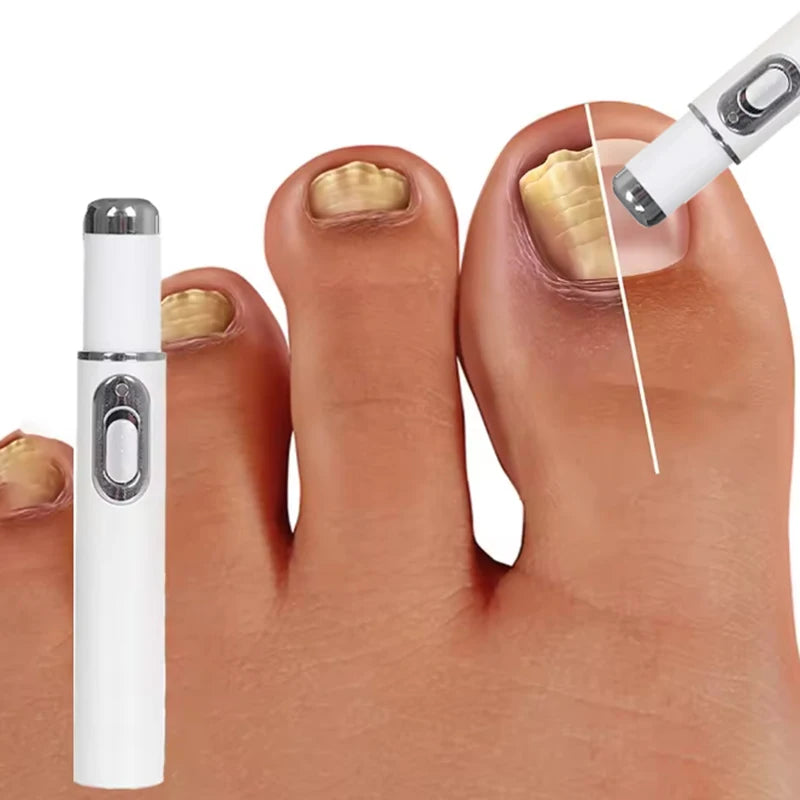 Fifth Gen Nail Laser Pen for Effective Onychomycosis Treatment